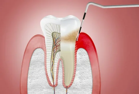 Самая коварная болезнь зубов и дёсен – пародонтит