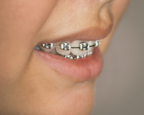 Как вылечить кривые зубы у подростка?