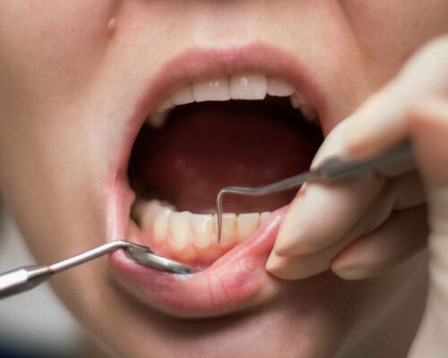 Как избавиться от страха перед походом к зубному врачу