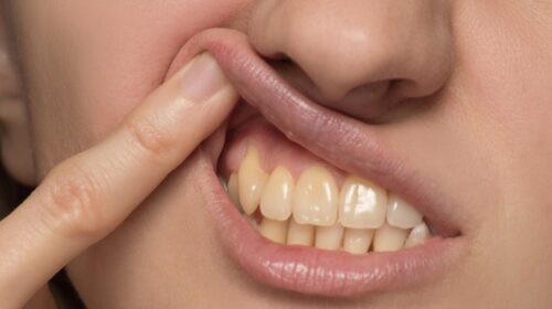 Как избежать желтизны зубов
