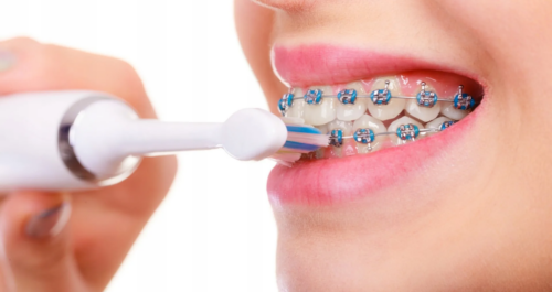 Особенности ухода за зубами у людей с брекетами